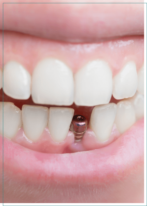 Close up of person smiling with a dental implant in Boise