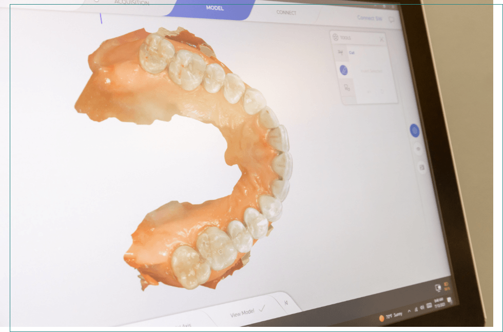 Computer monitor showing digital model of row of teeth