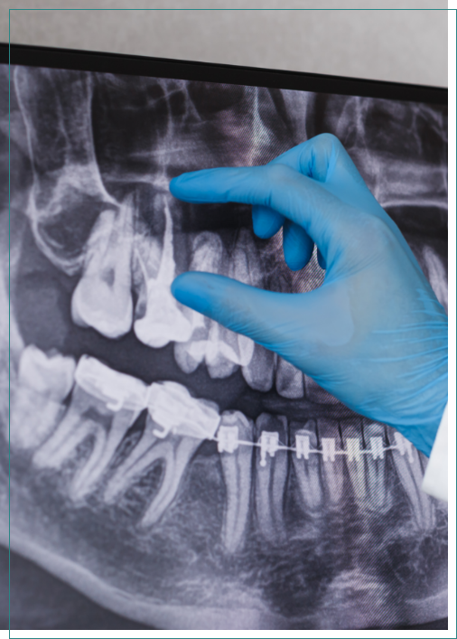Dentist looking at X ray of tooth that needs root canal treatment