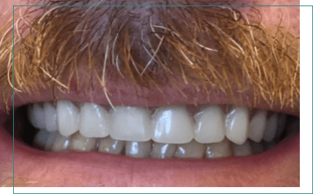 Close up of man with full set of white teeth