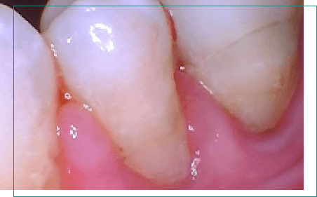 Tooth after fixing discoloration and damage