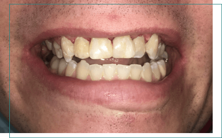 Close up of teeth with natural looking restorations