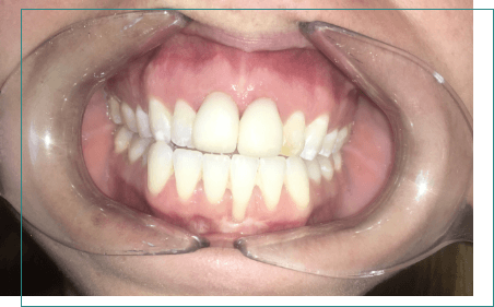 Mouth after fixing stained teeth