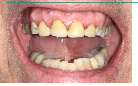 Close up of mouth after dental treatment
