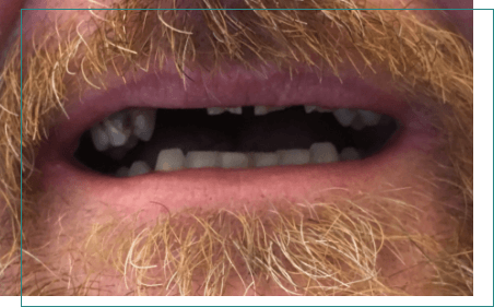 Close up of man with several missing and discolored teeth
