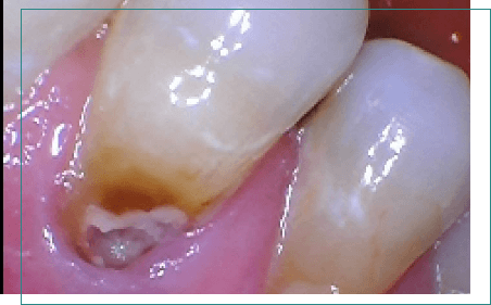 Tooth with discoloration and damage near the root