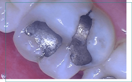 Tooth with two metal fillings