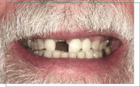 Man with white beard missing one upper tooth