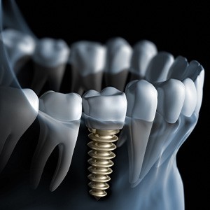 Dental implant placed within the jawbone