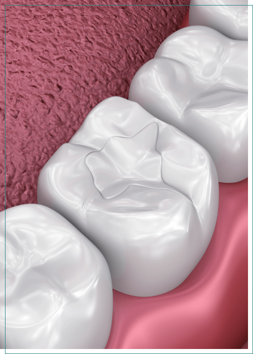 Illustrated tooth with a natural looking filling
